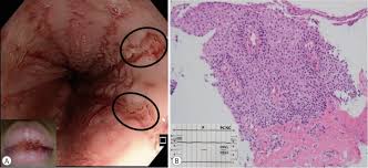 Cytomegalovirus (cmv) and congenital cmv infection. A Case Of Eosinophilic Esophagitis Associated With Herpes Esophagitis In A Pediatric Patient