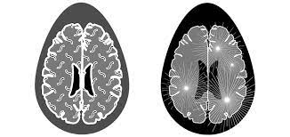 Una dintre cele mai frecvente afecţiuni neurologice ale adultului tânăr, scleroza multiplă este tot mai frecvent diagnosticată în zilele noastre. Scleroza Multipla Cauze Simptome Tratament Si Dieta Recomandata Dieta Ketogenica