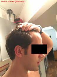 It's so strong, in fact, that even users who are not particularly susceptible to androgenic alopecia report hair loss from winstrol. Short Anabolic Cycle Bye Bye Hairline Hello Balding Baldtruthtalk Com