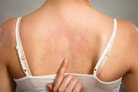 Declansarea bolii determina o eruptie cutanata raspandita pe tot corpul si simptome asemanatoare gripei, inclusiv febra mare, tuse, secretii nazale si oculare. Urticaria Care Sunt Simptomele De Ce Apare Si Cum O Tratezi Reginamaria Ro