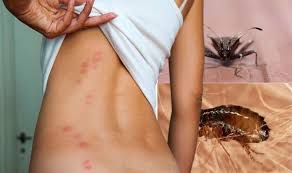 The difference between a bedbug bite and a flea bite is that the center of a bedbug bite is red. Bed Bug Bites How To Tell A Bed Bug Bite From A Flea Bite Key Sign Sound Health And Lasting Wealth