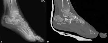 Image result for Calcaneus Compression Fracture