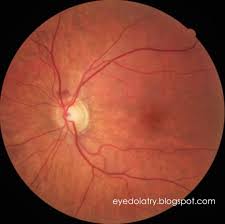 What S That In My Retinal Photo Hemorrhage At The Nerve Eyedolatry
