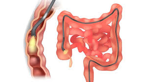 During your procedure, your doctor can: Will Disposable Colonoscopy Devices Replace Reusables