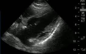 In cardiomyopathy, the heart muscle becomes thick or rigid, which can weaken the heart. Ultrasound Of Reverse Takotsubo Resus Review