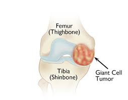 Even the smallest tumors can cause symptoms in certain organs, such as the brain. Giant Cell Tumor Of Bone Orthoinfo Aaos