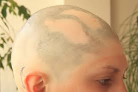 Most effective herbal treatment for alopecia areata and herbs for alopecia areata. Leben Mit Kreisrundem Haarausfall Zerbrechliche Schonheit Barfuss Das Sudtiroler Onlinemagazin