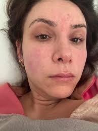 Has anyone else experienced nausea with doxy and rifampin?