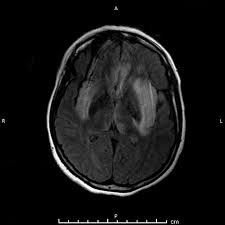 Mri showing extensive necrotizing sequelae. Herpes Encephalitis Ct Scan Ct Scan Machine