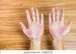 Rash On Palms Images Stock Photos Vectors Shutterstock