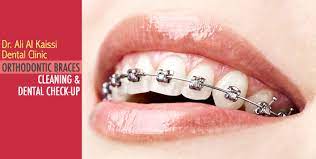 The smile for a lifetime program could win your child free braces via an orthodontic scholarship. Orthodontic Braces Scaling Polishing Cobone