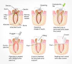 Therefore some root canal pain after the treatment, generally a moderate dull pain. Root Canal Treatment T32 Dental Group