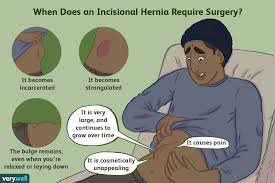 Since more than seven year there are no symp. Incisional Hernia What It Is And How It S Treated