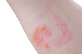 25 Best Home Remedies For Poison Ivy Rash Styles At Life Poison Ivy Remedies Poison Ivy Treatment Poison Ivy