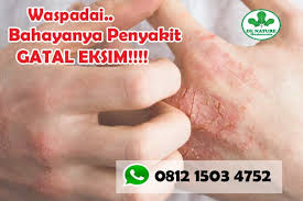 Obat eksim atopik alami paling ampuh. Storymapjs Daftar Obat Eksim Terbaik Di Apotik Kimia Farma