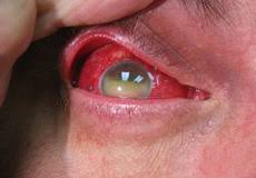 With few exceptions, a copious amount of water is the preferred way to flush eyes. Chemical Splash In The Eye