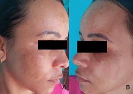 ANÁLISE DO USO DE PROTETOR SOLAR ASSOCIADO A VITAMINA C NO TRATAMENTO DO  MELASMA