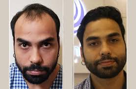 Hair transplant surgery has been heralded by some as the holy grail cure of hair loss. Pained By Your Receding Hairline Why You Should Consider A Hair Transplant Business Standard News