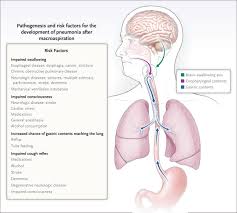 Image result for Pneumonia
