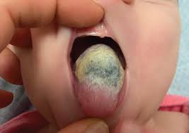 Michael friedman on webmd recommends practicing good oral hygiene and to drink plenty of water throughout the day. Infant S Black Hairy Tongue Lingua Villosa Nigra