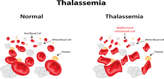 My Life With Thalassemia Minor On A Plant Based Diet