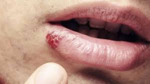 Cancerul La Gat Cancerul Faringian Cancerul Laringian Cancerul Amigdalian Cancer De Laringe E Faringe