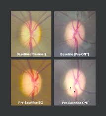 The optic disc cupping has been recognized as an important characteristic of the glaucomatous process since the 19th century. Cupping In A Representative Monkey Experimental Glaucoma Eg Left And Download Scientific Diagram