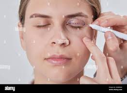 Fox eye surgery hi-res stock photography and images