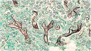 Micosis provocada por hongos del género mucor , rhizopus y absidia. Xz3f3ewg7euplm
