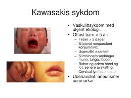 Ved risiko for sprut anbefales sprutsikkert munnbind (type iir). Ppt Akutt Syke Barn Powerpoint Presentation Free Download Id 3609151