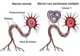Su participación de las condiciones inflamatorias tales como la esclerosis múltiple puede ilustrar su importancia en la función cognitiva global. Esclerosis Multiple Steemit