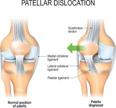 The main symptoms of tendonitis are: What Is The Recovery Time For A Dislocated Patella