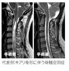 髄性筋萎縮症 | 慢性炎症性脱髄性多発神経炎 | ライソゾーム病(ファブリー病を除く). å°‚é–€è¨ºç™‚ å¤§é˜ªåŒ»ç§'è–¬ç§'å¤§å­¦ è„³ç¥žçµŒå¤–ç§'å­¦æ•™å®¤