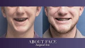 Christopher johnson, dds is a oral & maxillofacial surgery specialist in longview, tx. Jaw Orthognathic Surgery About Face Surgical Arts