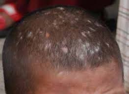 Oral or topical steroids may sometimes be prescribed for treatment, depending upon the severity, although this has not been shown to reduce permanent hair loss. Symptoms And Treatment Of Ringworm Infections British Journal Of School Nursing