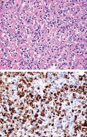 There are different mesothelioma cells and each of them should be treated with a different diagnosed with mesothelioma? Problems In Mesothelioma Diagnosis Addis 2009 Histopathology Wiley Online Library