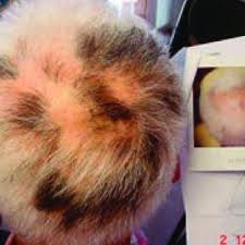 Does spermatorrhoea cause hair loss? Sisaipho With Targetoid Regrowth Download Scientific Diagram