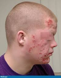 All the symptoms i had matched up to what i seen on google. Herpes Gladiatorum