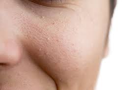 Millium Puntos Blancos De La Piel Por Que Salen Y Como Eliminarlos El Blog De Cosmeticos24h