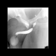 Image result for Retrograde Urethrogram
