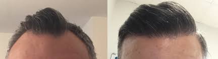 See more top hair loss doctors in charlotte. Advanced Hair Transplants Hair Restoration Max Density