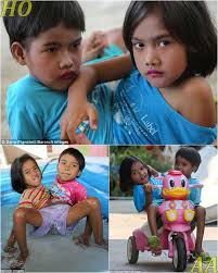 1 in 2.5 million rare cases: Why did Pin-Pan become Thailand's new symbol  of optimism? Walking on his hands like a "crab crawling", riding a tricycle:  Pin-Pan made the whole school amazed.