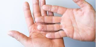 Telapak tangan gatal adalah kondisi yang semua orang pasti pernah mengalaminya. Selalu Gatal Tapak Tangan Apa Puncanya Bukan Bermaksud Dapat Duit Ya Perubatan Kesihatan Forum Cari Infonet