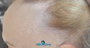 Forum beiträge / themen letzter beitrag; Die Frontal Fibrosierende Alopezie Im Detail Symptome Heilung