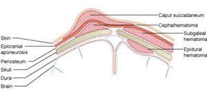 Schwabbelige Beule Am Kopf Forum Baby Urbia De
