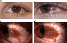 Image result for conjunctival melanoma
