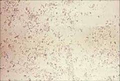 Urine Crystals Flashcards Cram Com
