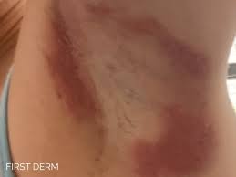 Image result for Intertrigo under breasts