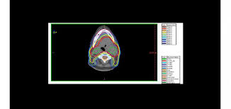 Image result for Intensity-Modulated Radiation Therapy