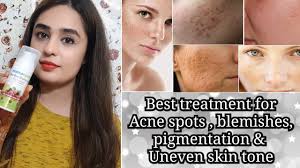 The spots will more often than not appear on your face, shoulders, upper section of your back and forearms as well as at the back of your hands. Best Face Cream For Blemishes Pigmentation Acne Scars Uneven Skin Tone à¤« à¤‰ à¤¡ à¤¶à¤¨ à¤¸ à¤ªà¤¹à¤² à¤‡à¤¸ à¤²à¤— à¤ Youtube